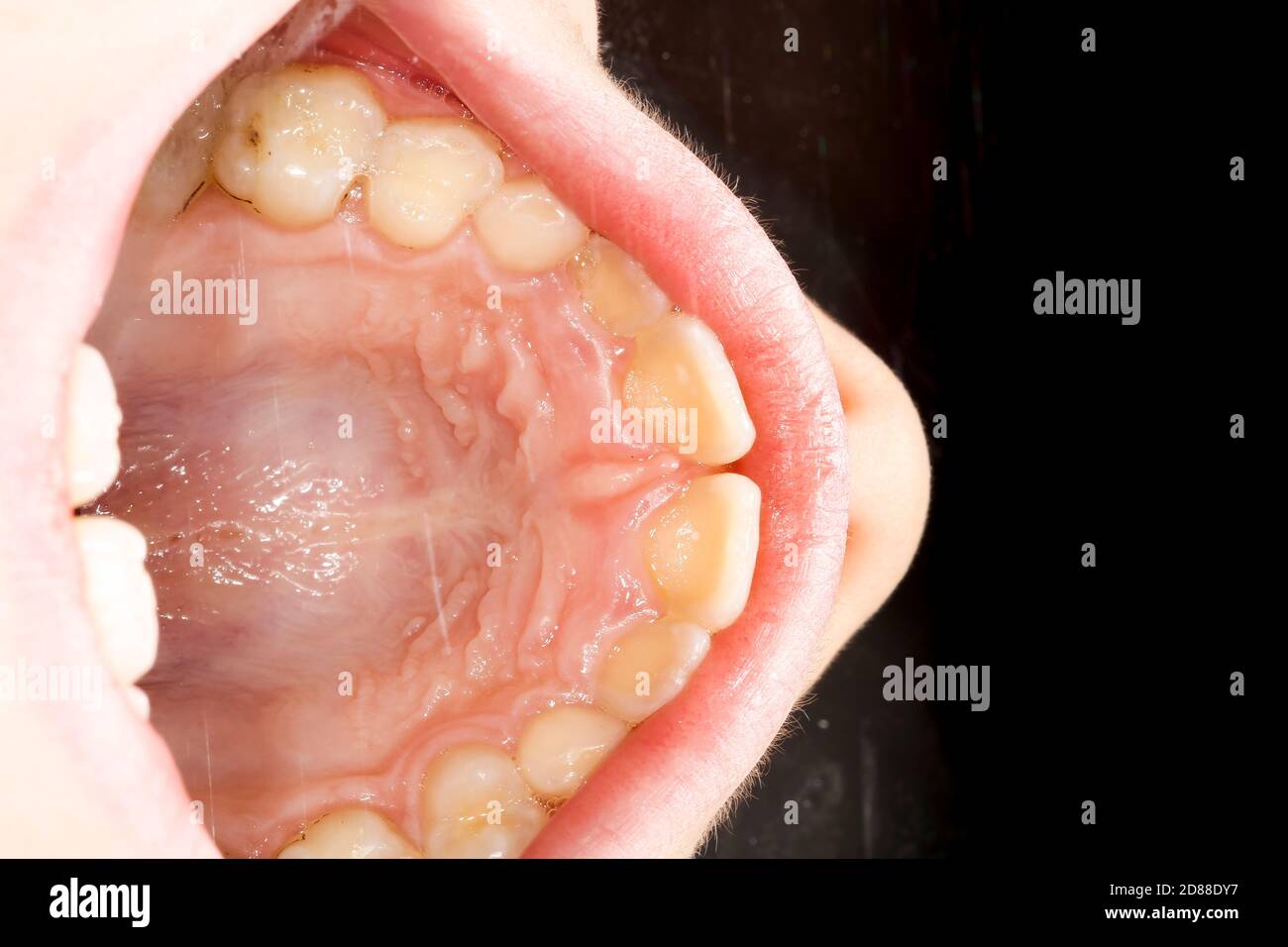 Enfant malsain prothèse d'adolescent, tartre sur les dents frontales Banque D'Images