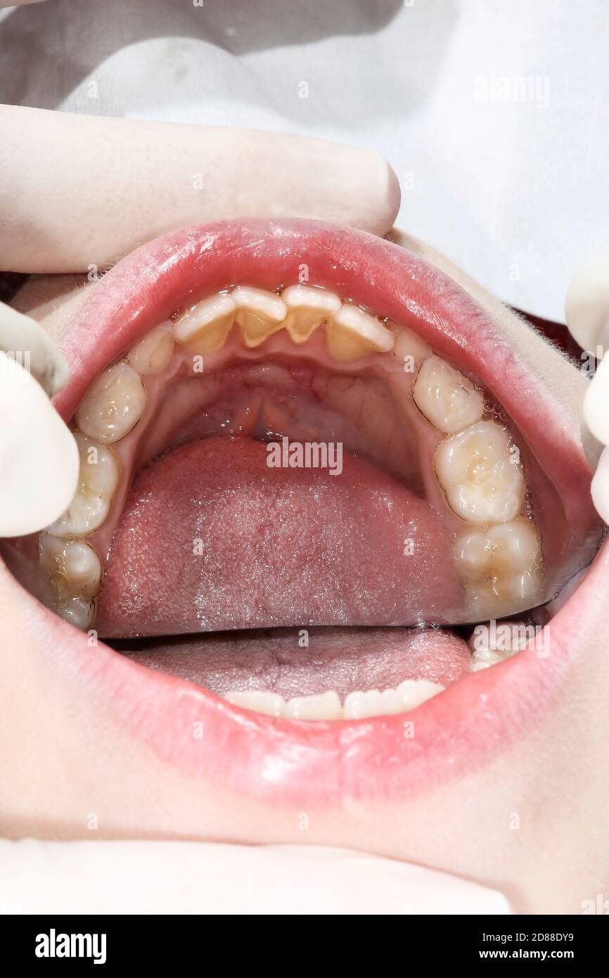 Enfant malsain dentition adolescente, tartre sur les dents frontales, avec miroir dentiste dans la bouche Banque D'Images