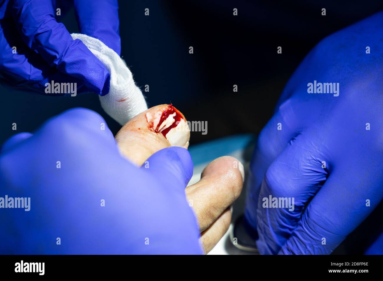 Série de traitement des ongles de crapaule incarnés. Partie infectée de l'ongle du pied supprimée. Banque D'Images