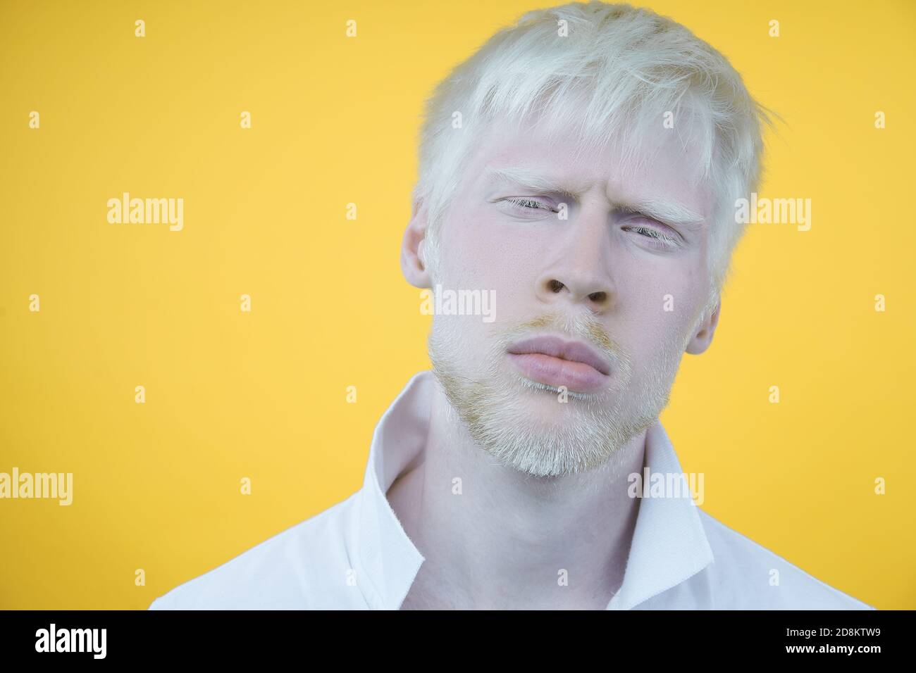 Albinisme triste albino homme blanc peau cheveux studio habillé t-shirt isolé fond jaune. Écarts anormaux. Aspect inhabituel. Anomalie de la peau B Banque D'Images