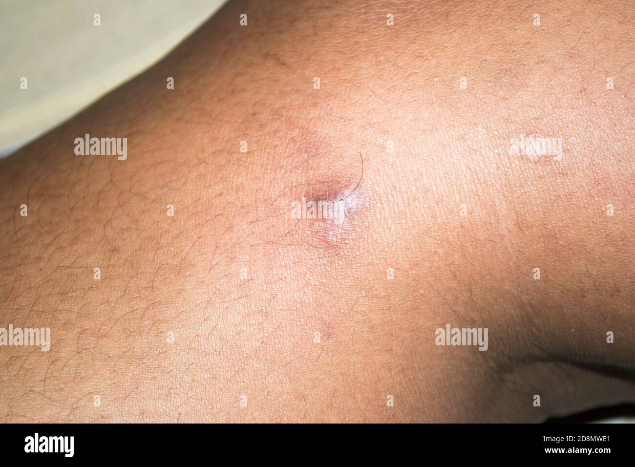 Cicatrice keloïde (cicatrice hypertrophique) - formation d'un type de cicatrice au site d'une lésion cutanée guérie. Banque D'Images