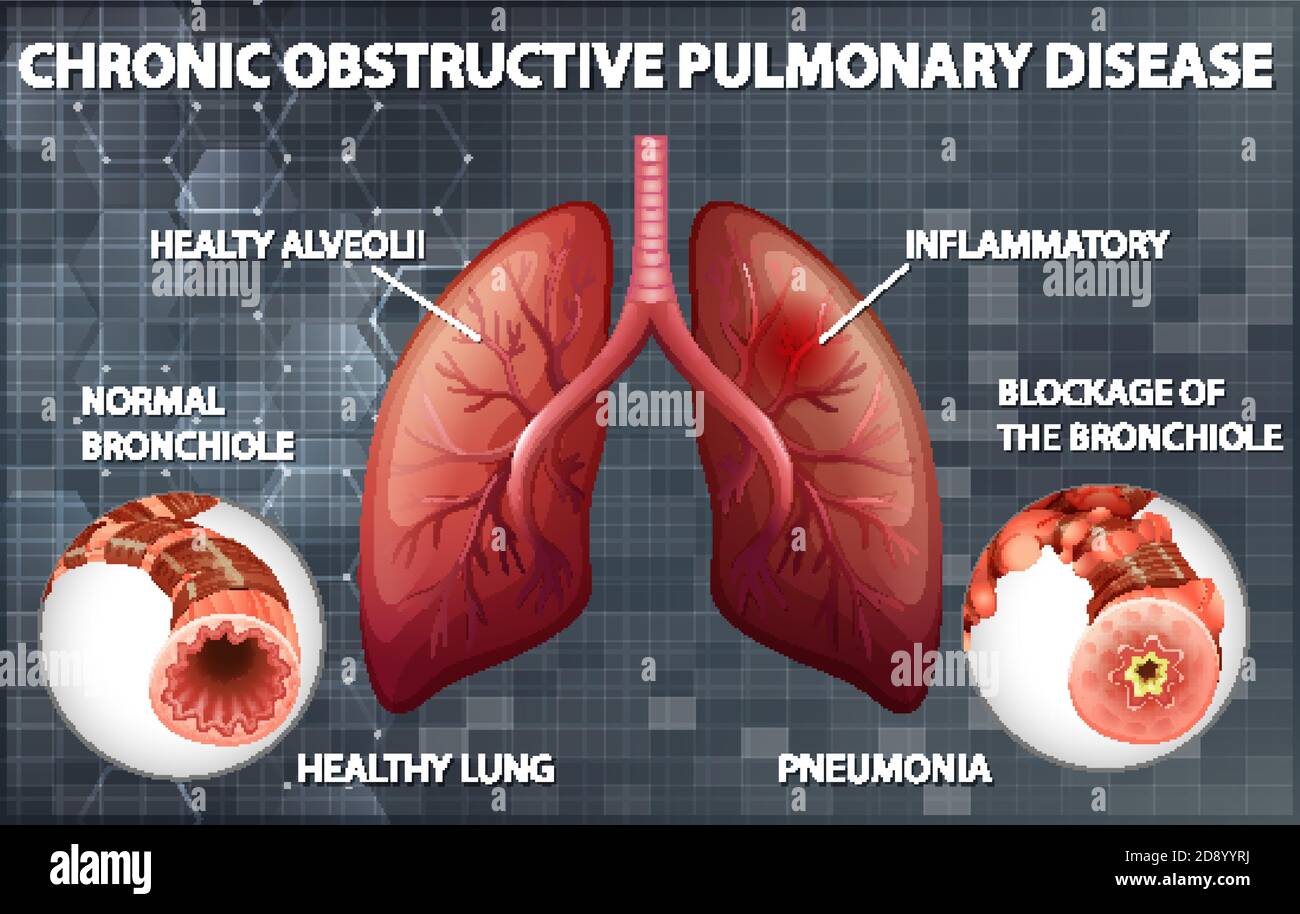 Illustration de la maladie pulmonaire obstructive chronique Illustration de Vecteur