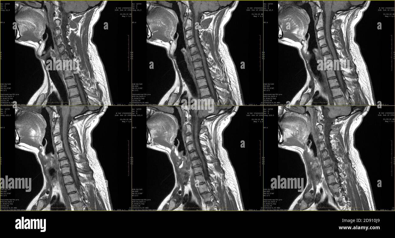 Ensemble de 6 acquisitions IRM sagittales de la zone du cou de mâle de 34 ans de race blanche avec extrusion paramédiale bilatérale de Segment C6-C7 avec radiculopathie Banque D'Images