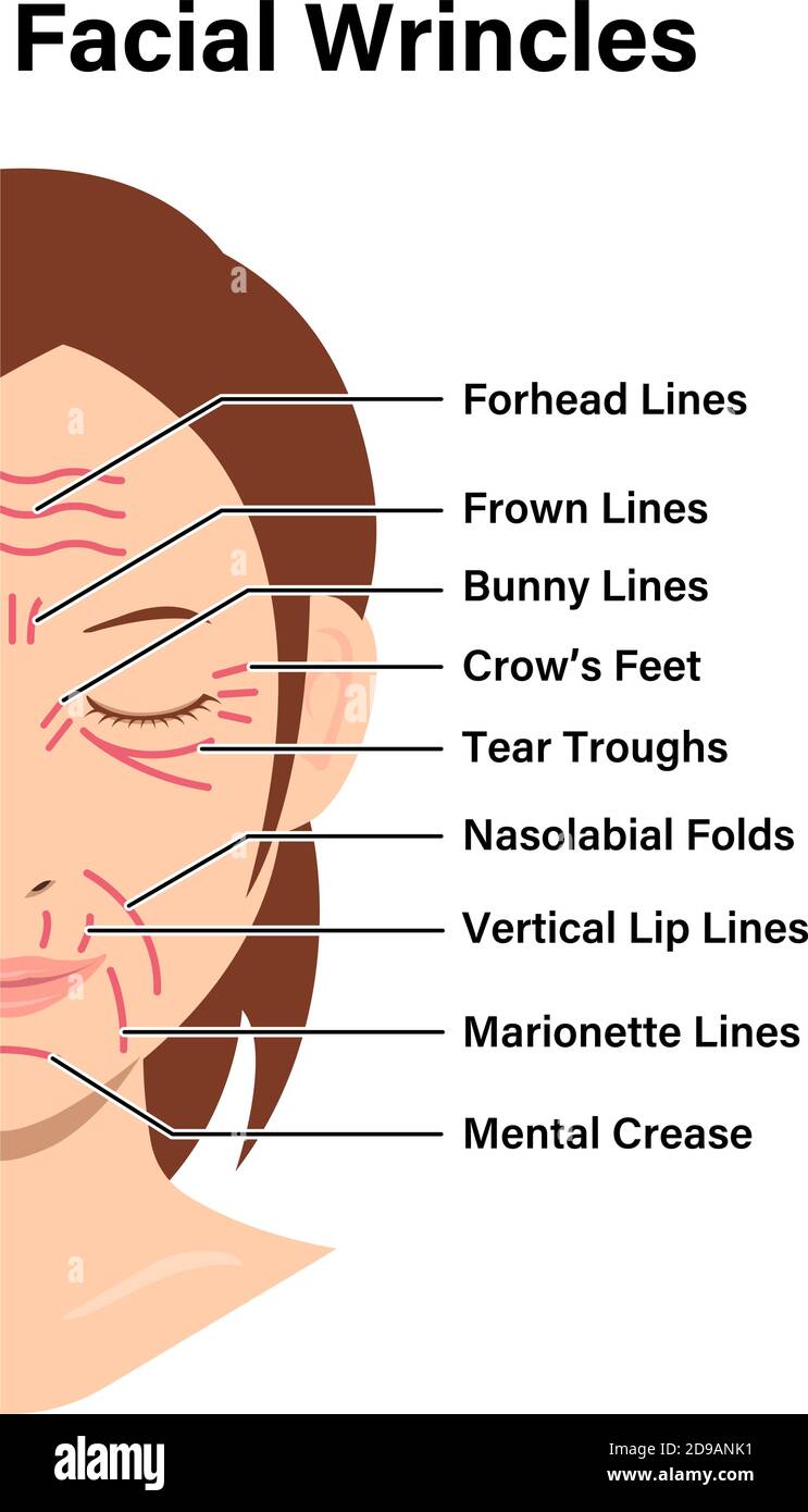 Illustration vectorielle des rides faciales ( visage féminin ) Illustration de Vecteur