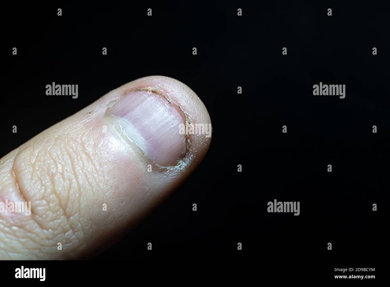 l'habitude de piquer vos ongles. Gros plan sur les ongles du pied-à-queue. Banque D'Images