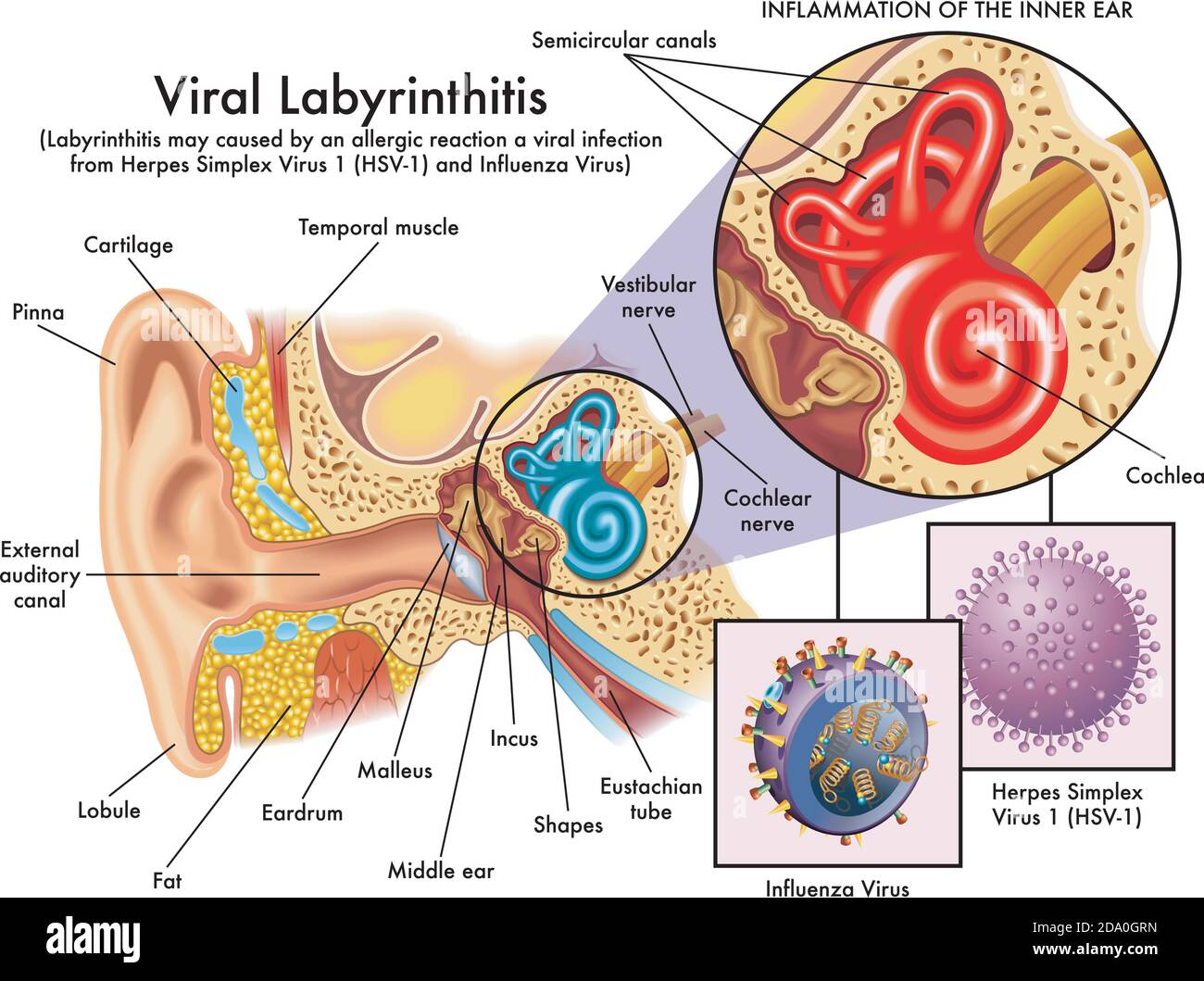 Illustration d'une inflammation de l'oreille interne causée par l'herpès  simplex ou un virus de la grippe Image Vectorielle Stock - Alamy