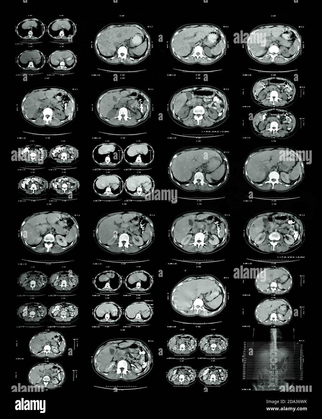 Imagerie par résonance magnétique de la fusion thoracique et thoracique de la colonne vertébrale Banque D'Images