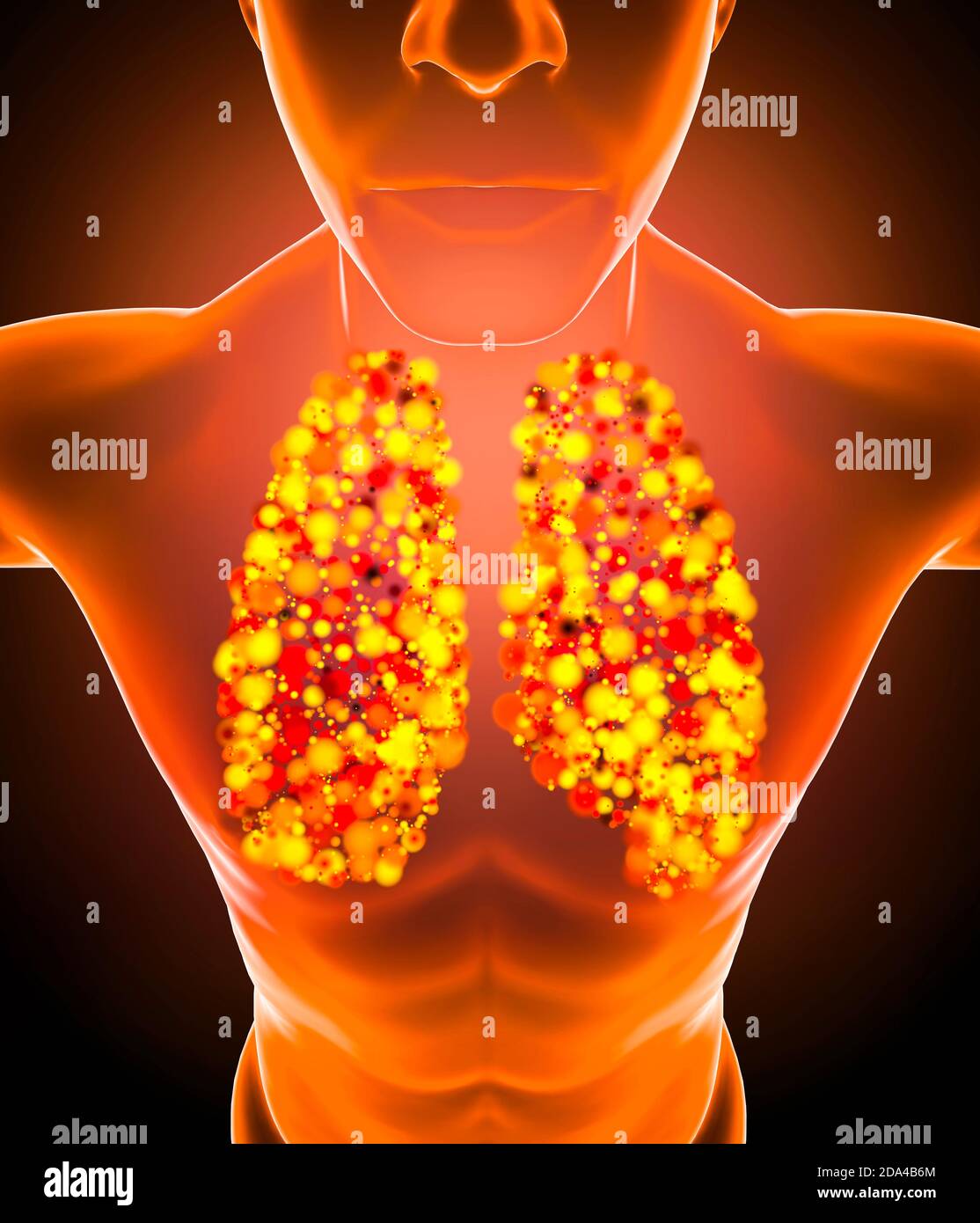 Anatomie humaine, problèmes avec le système respiratoire, poumons gravement endommagés. Pneumonie bilatérale. Covid-19, coronavirus. Patient et fumée. Fumeur. 3d Banque D'Images