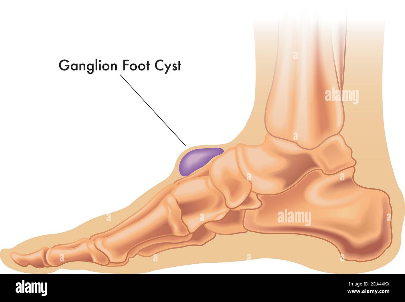 Illustration d'un kyste de ganglion sur le pied avec annotation Image  Vectorielle Stock - Alamy