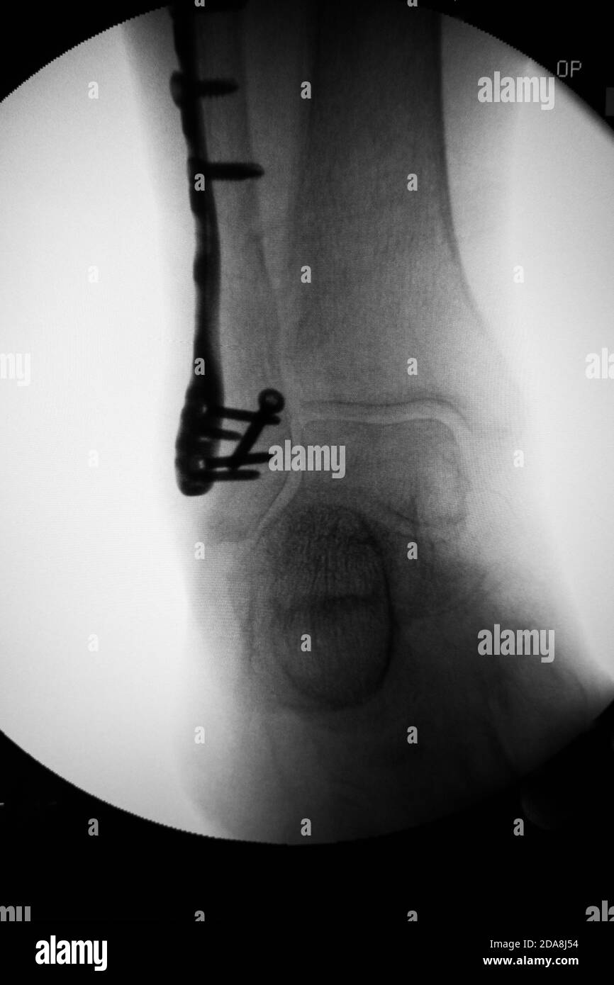 Une radiographie montre une plaque en titane qui stabilise une fracture de la cheville Banque D'Images