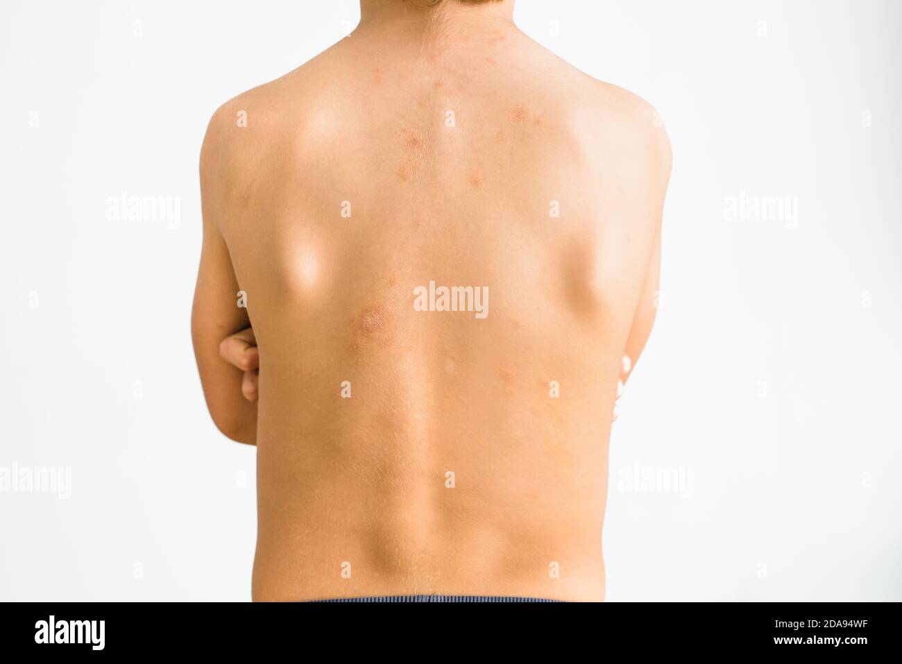 Pyrosis Enfant Dos d'un garçon de 7 ans atteint de pityriasis rosea gibert, une ...