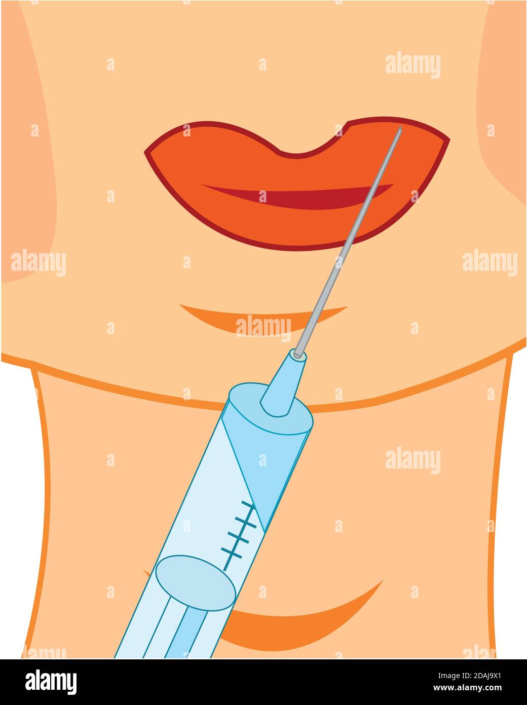 Augmenter les lèvres à l'aide de la procédure botox Illustration de Vecteur