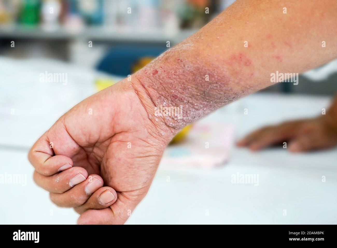 Eczema skin blisters Banque de photographies et d'images à haute ...