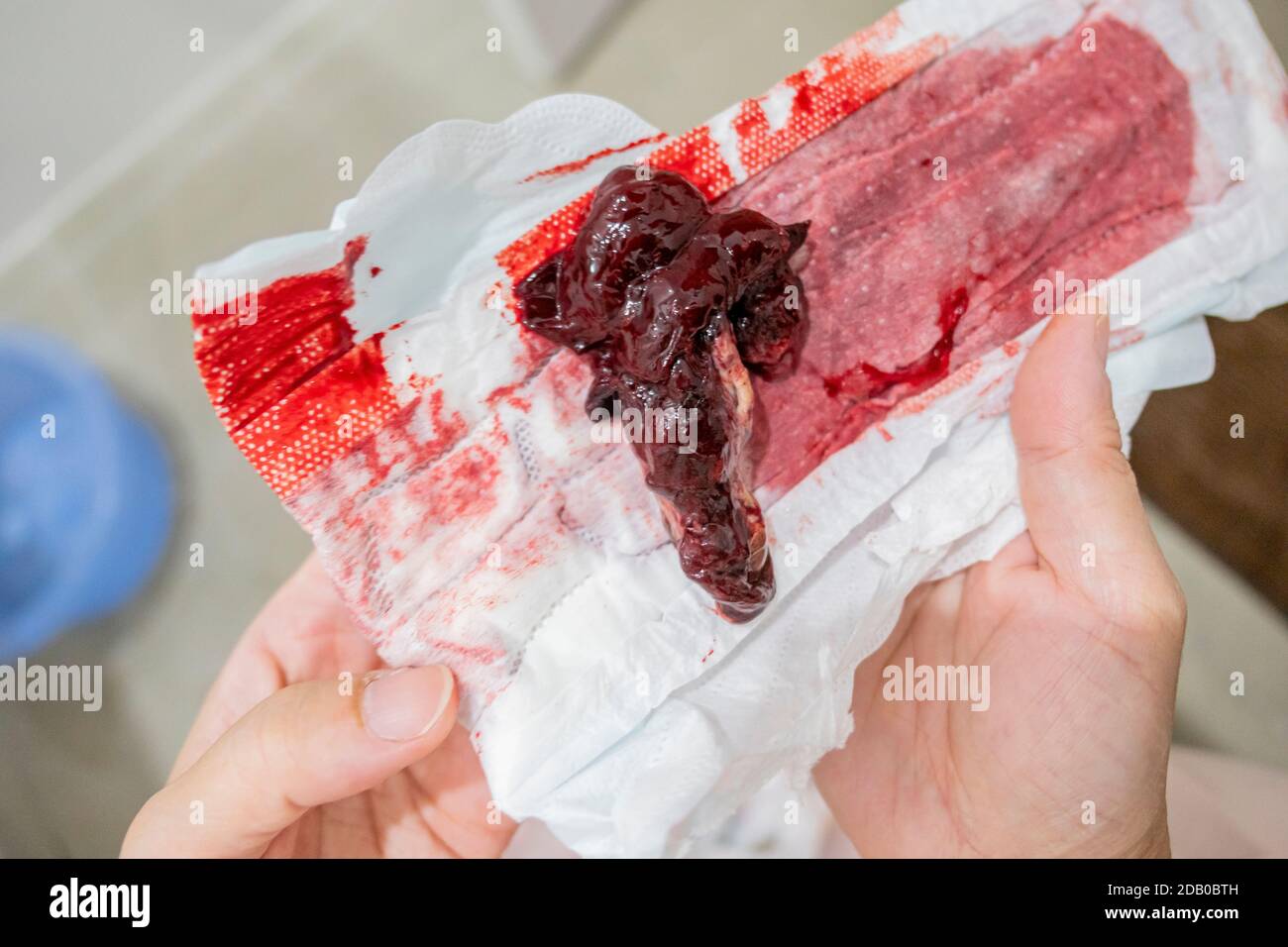 Le sang de fausse couche sur la serviette montrant le signe de fausse couche  sur la femme enceinte Photo Stock - Alamy