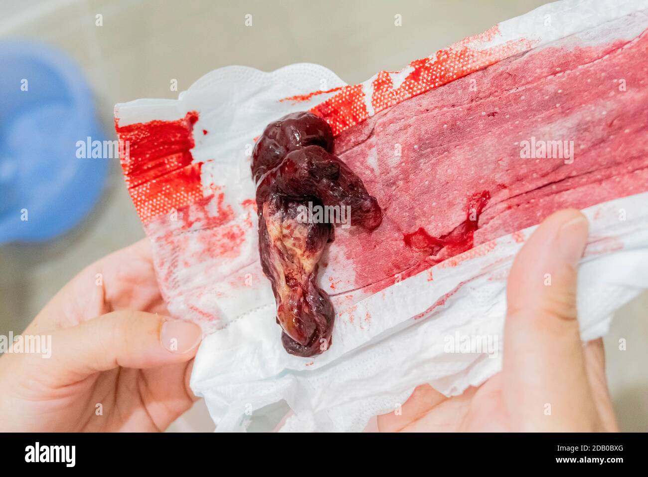 Le sang de fausse couche sur la serviette montrant le signe de fausse couche sur la femme