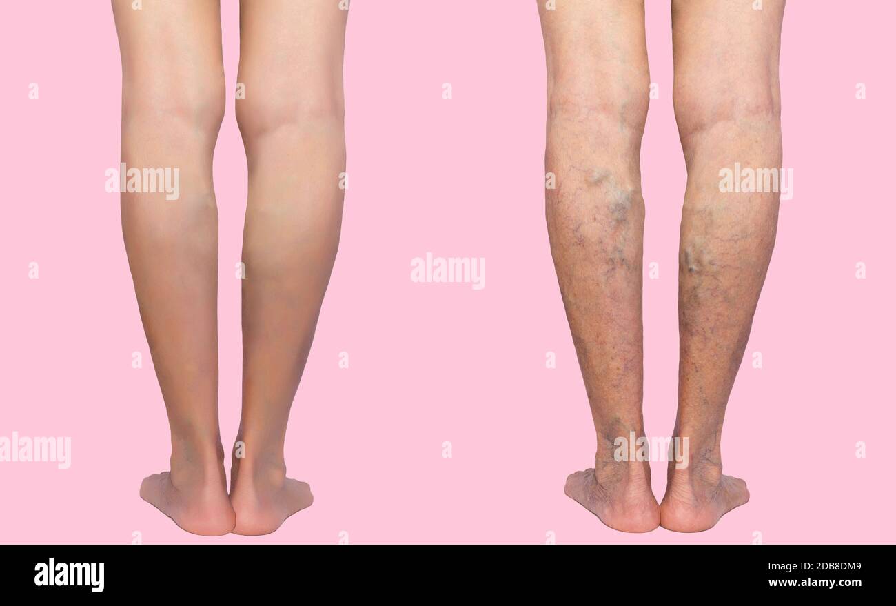 Traitement de varices avant et après. Varices sur les jambes des femmes âgées Photo Stock Alamy
