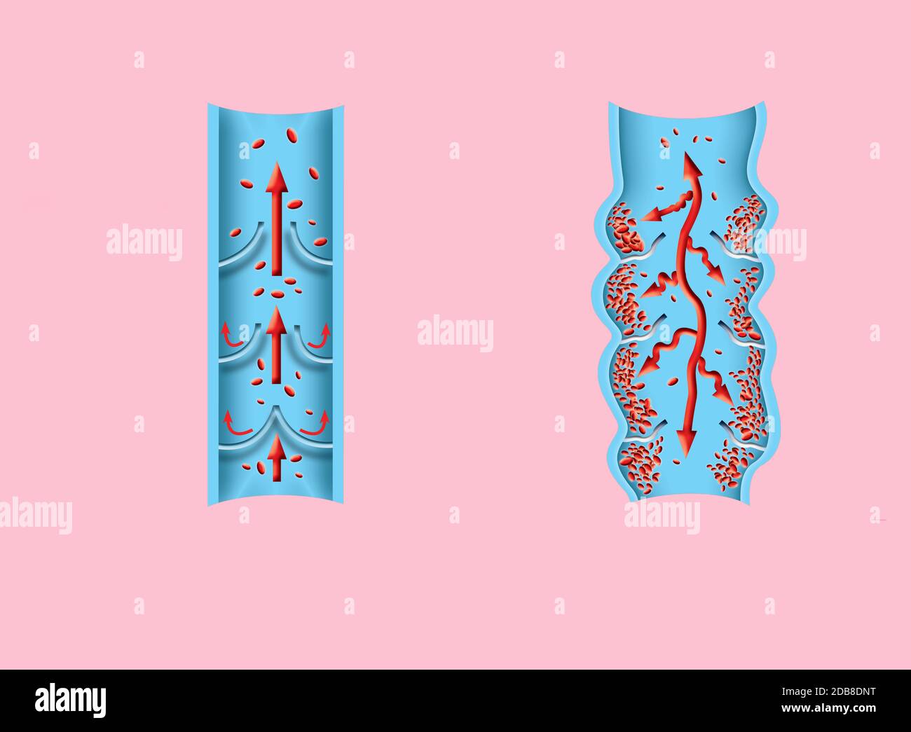 La thrombose. De la normale de la circulation sanguine vers la formation de caillots sanguins et clot, qui voyage dans le sang. L'embolie. Illustration pour la biologie, le medi Banque D'Images