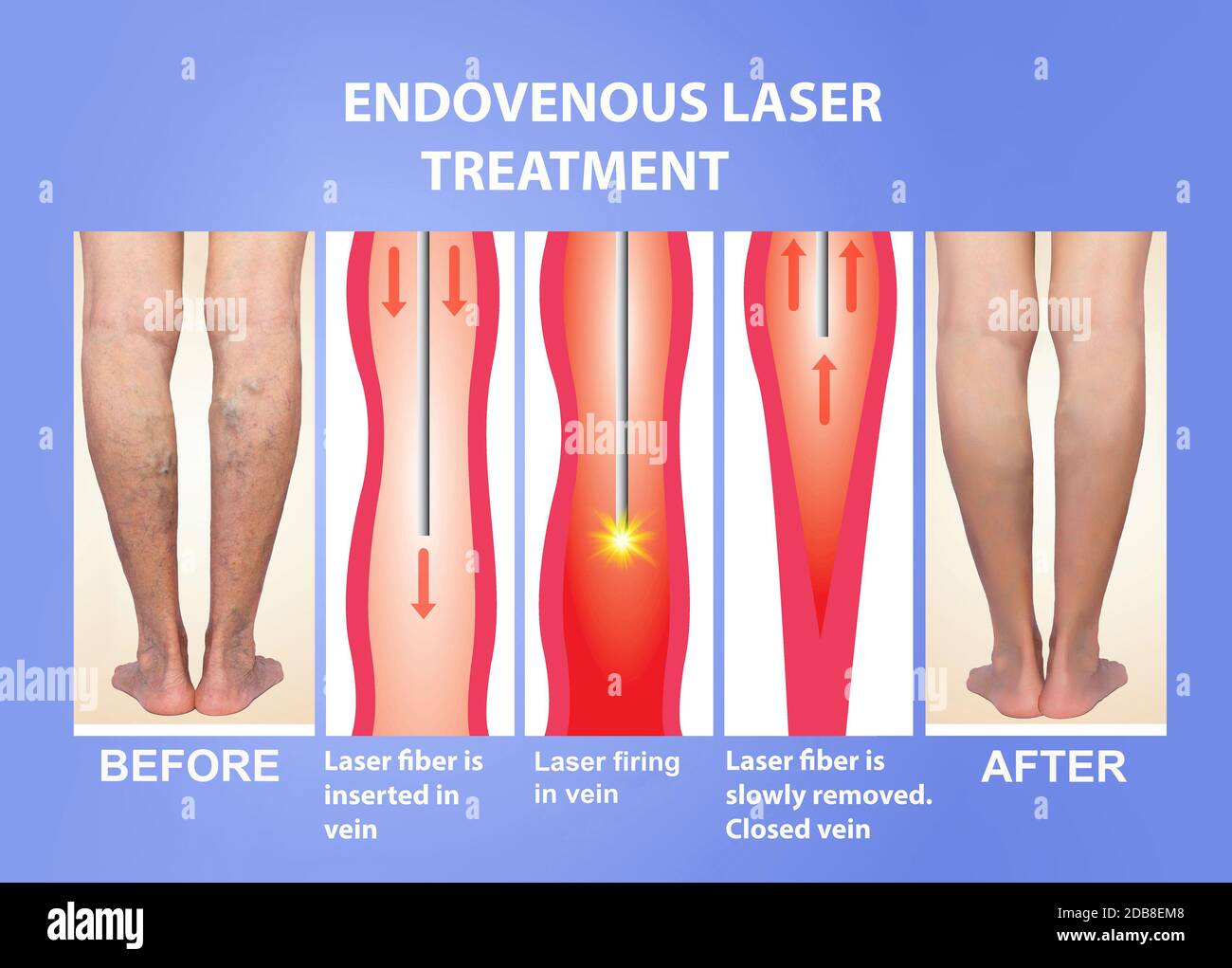 Varices. Laser endoveineux dans le traitement des jambes des femmes Photo  Stock - Alamy