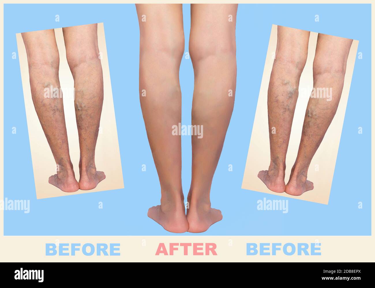 Traitement de varices avant et après. Varices sur les jambes des femmes âgées. Banque D'Images
