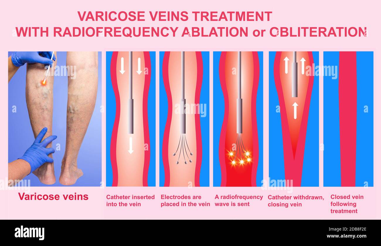 Varices. Le traitement par ablation par radiofréquence d'orobliteration les jambes des femmes Banque D'Images