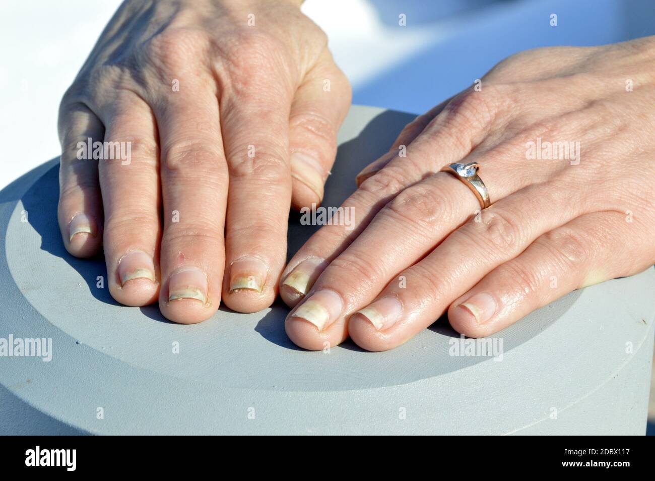 Infection fongique des ongles, onycholyse après shellac ou gel-vernis Banque D'Images