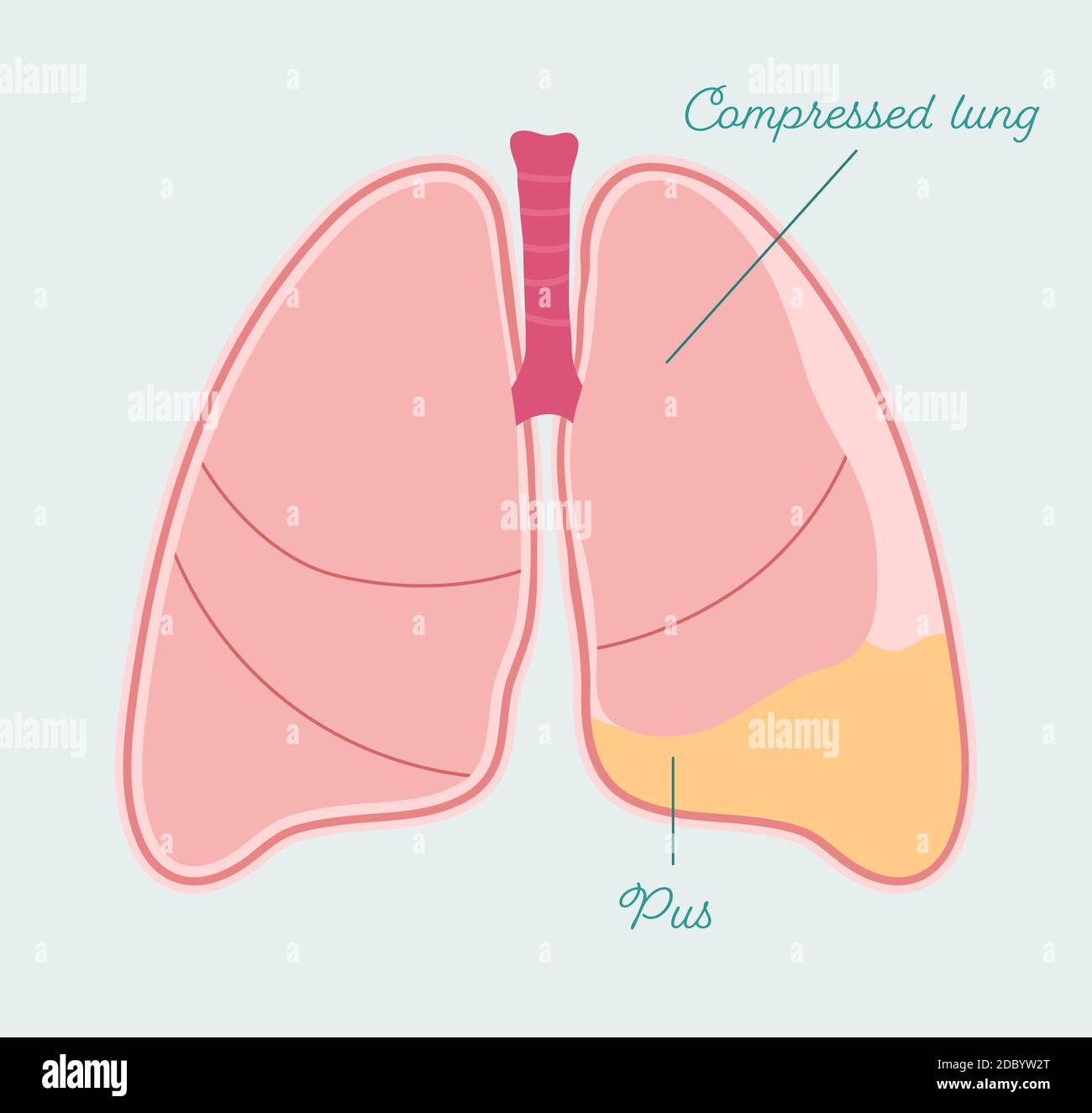 Empyema pleural - schéma anatomique de style dessiné à la main. Rassemblement de pus dans l'espace pleural, type d'épanchement pleural Illustration de Vecteur