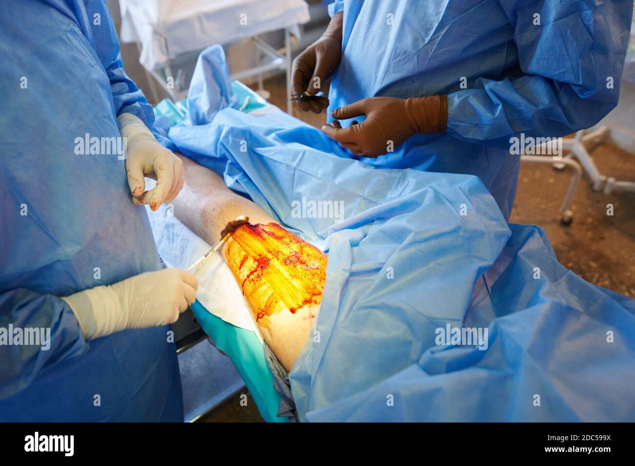 Chirurgie. Traitement du champ opératoire avec une solution antiseptique. Banque D'Images