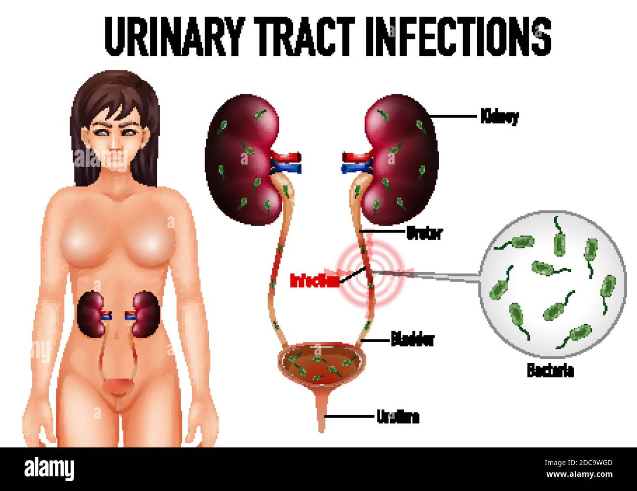 Illustration informative des infections des voies urinaires Illustration de Vecteur