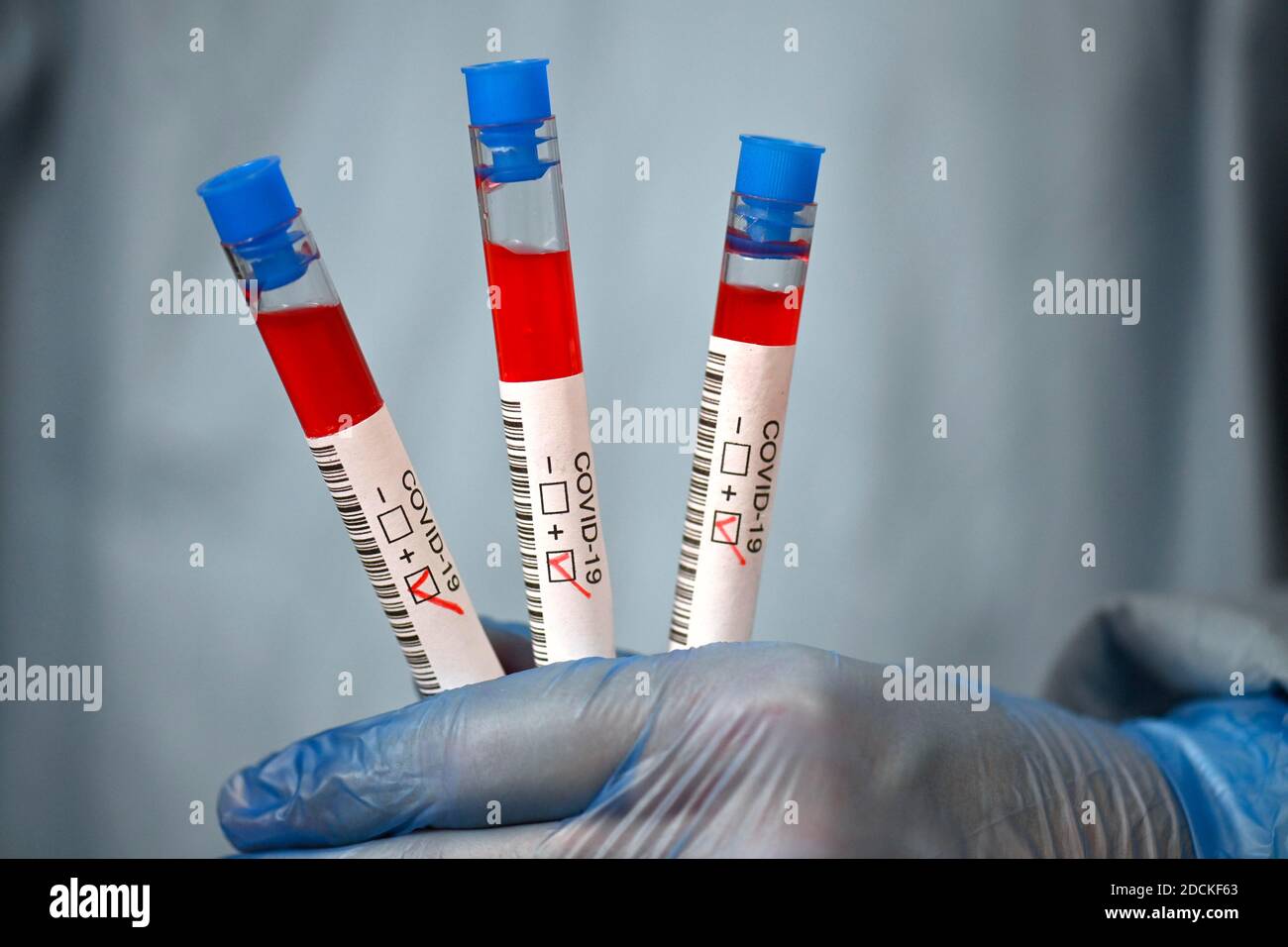 Résultat positif du test, personnel médical utilisant la RT-PCR, réaction en chaîne de la polymérase transcriptase inverse en temps réel, test de corona, crise de corona Banque D'Images