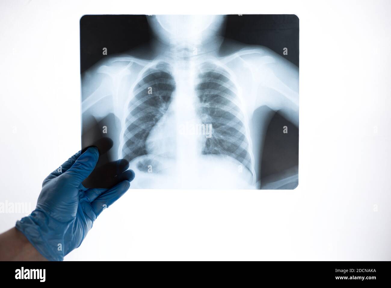 Vue rapprochée par rayons X des côtes et des poumons dans les mains d'un médecin en gants bleus. Le médecin examine la photo Banque D'Images