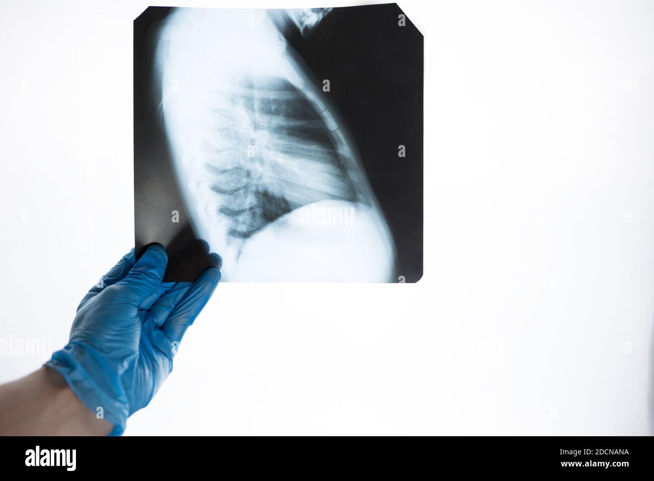 Vue en gros plan des côtes et des poumons dans les mains d'un médecin avec des gants bleus. Le médecin examine l'image de la pneumonie. Banque D'Images