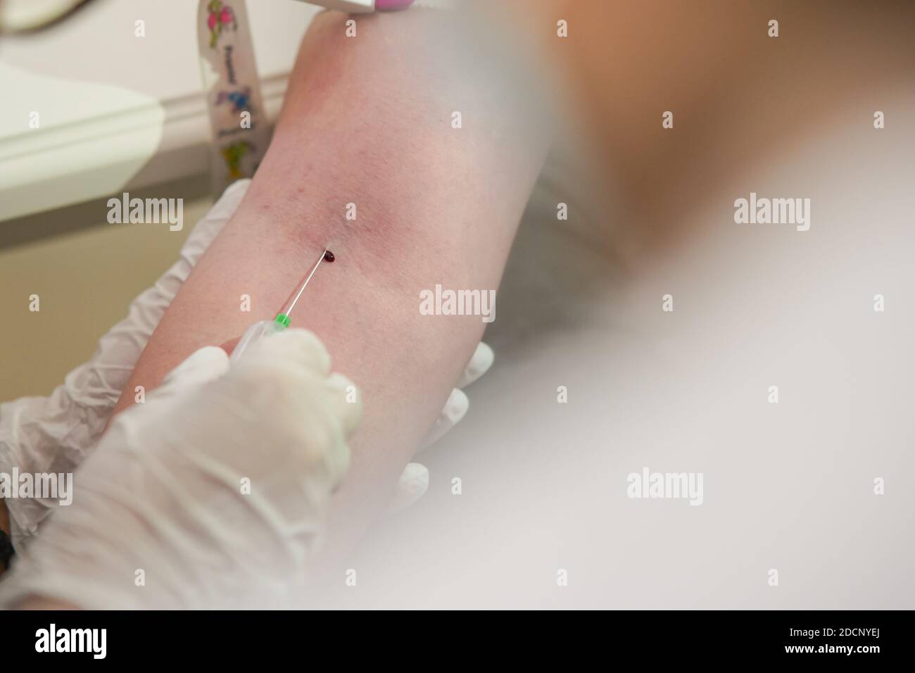 Main d'une infirmière qui insère une aiguille médicale pour le sang extraction hors de la veine sur une main d'un patiente avec une goutte de sang visible sur le dessus Banque D'Images