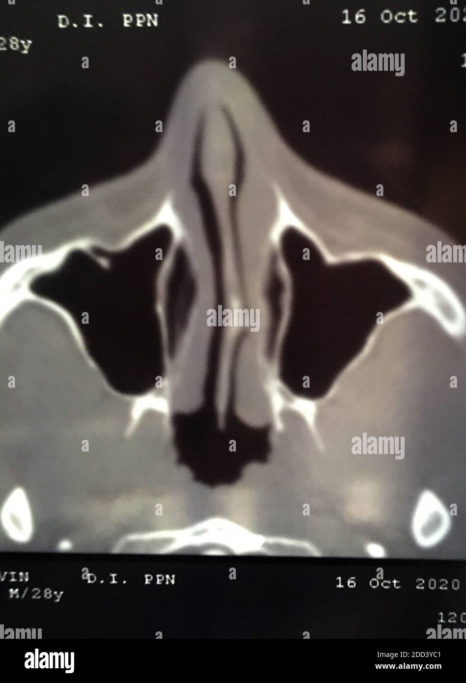 Image radiographique de la courbure faciale du septum nasal Banque D'Images