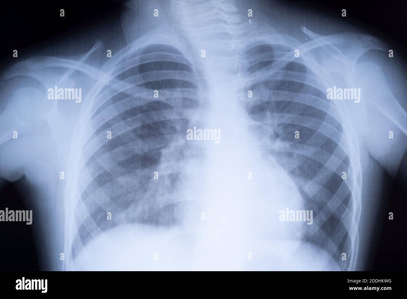 radiographie des poumons d'un adolescent. Pathologie pulmonaire. Radiographie avant de la poitrine d'un enfant Banque D'Images