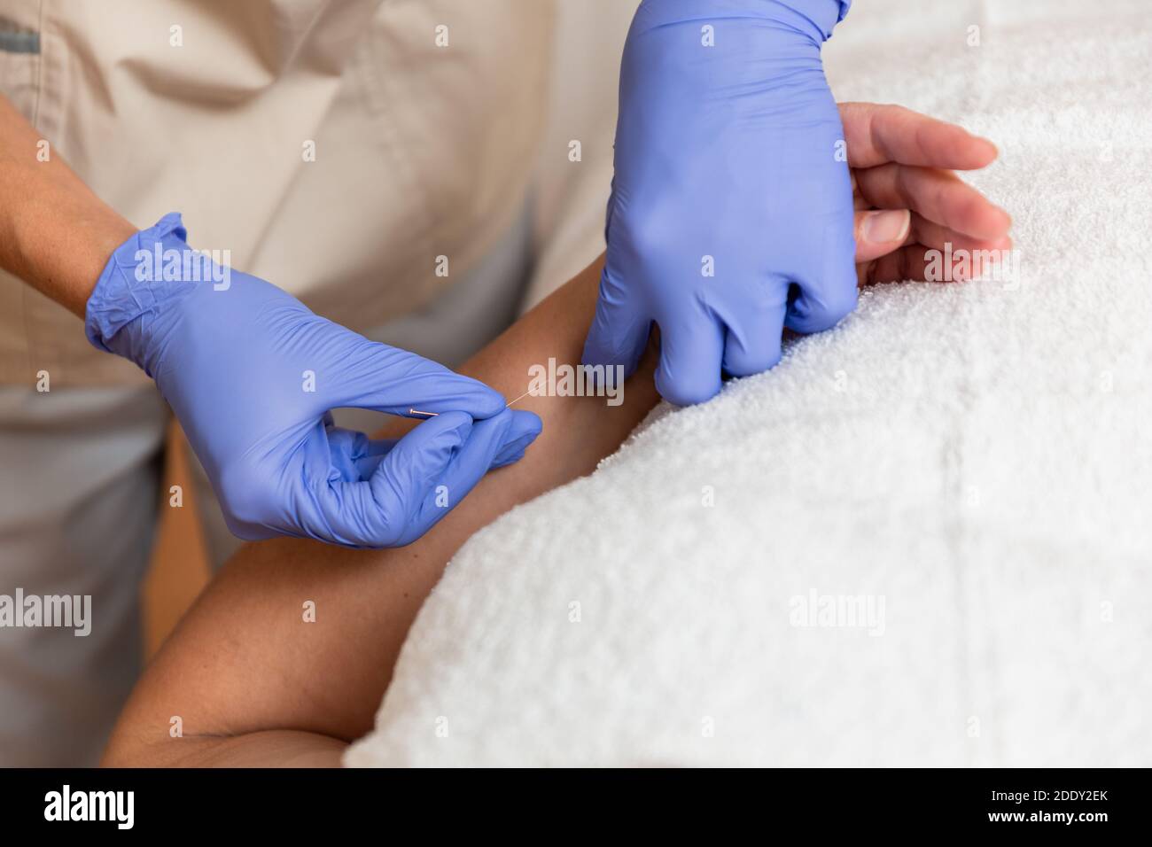 kinésithérapeute donnant le traitement avec l'acupuncture à aiguille sèche au patient dedans les mains Banque D'Images