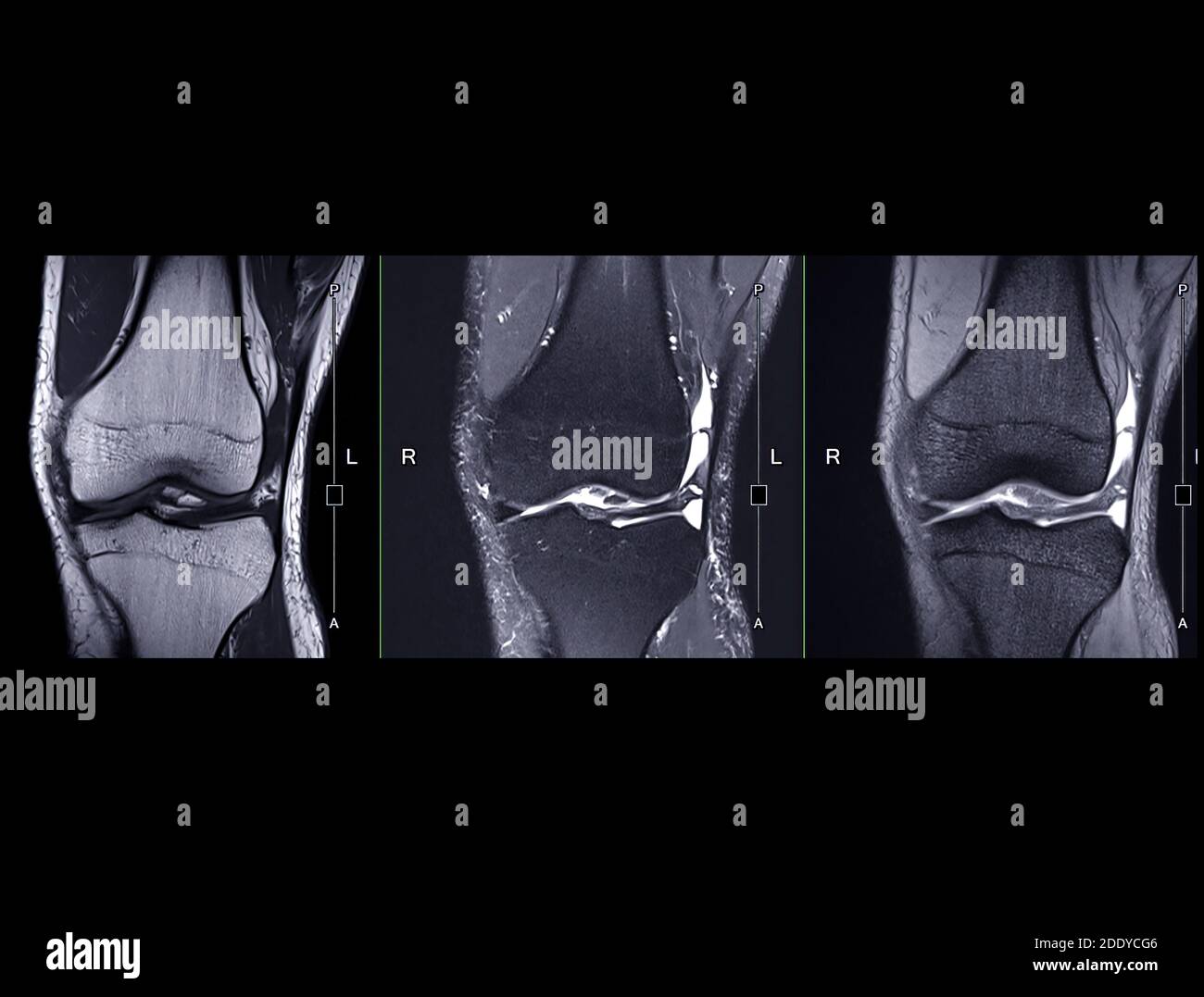 Imagerie par résonance magnétique ou comparaison IRM du genou vue coronale pour détecter la déchirure ou l'entorse du ligament croisé antérieur (ACL). Banque D'Images