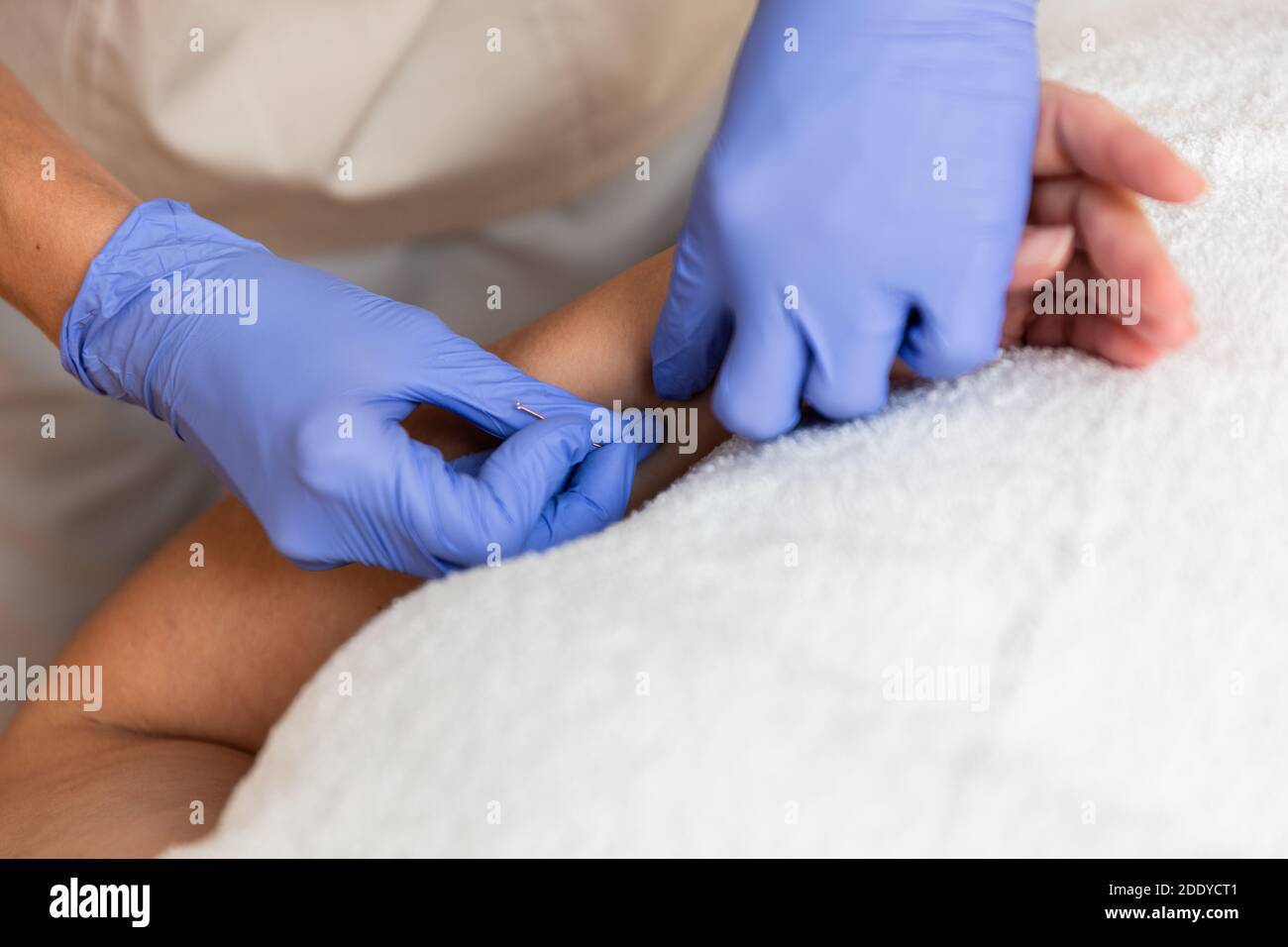 kinésithérapeute donnant le traitement avec l'acupuncture à aiguille sèche au patient dedans les mains Banque D'Images