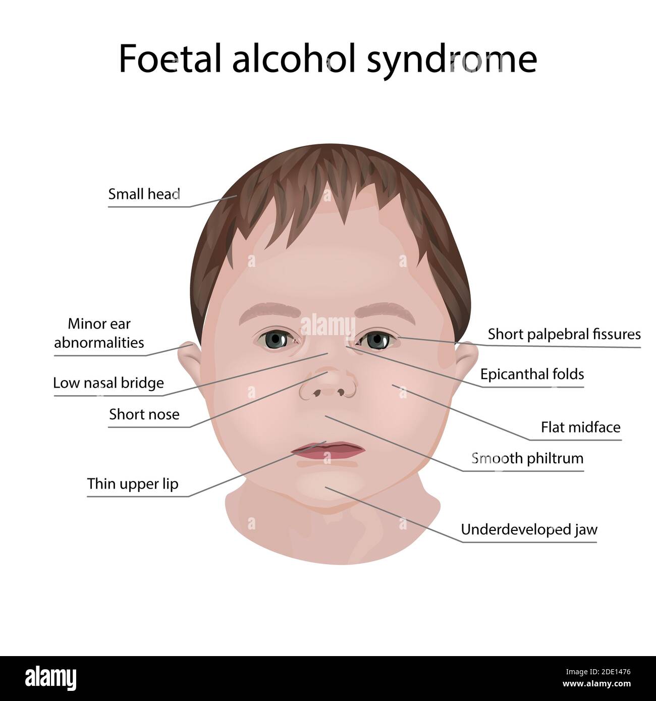 Syndrome de l'alcool fœtal, illustration Photo Stock - Alamy