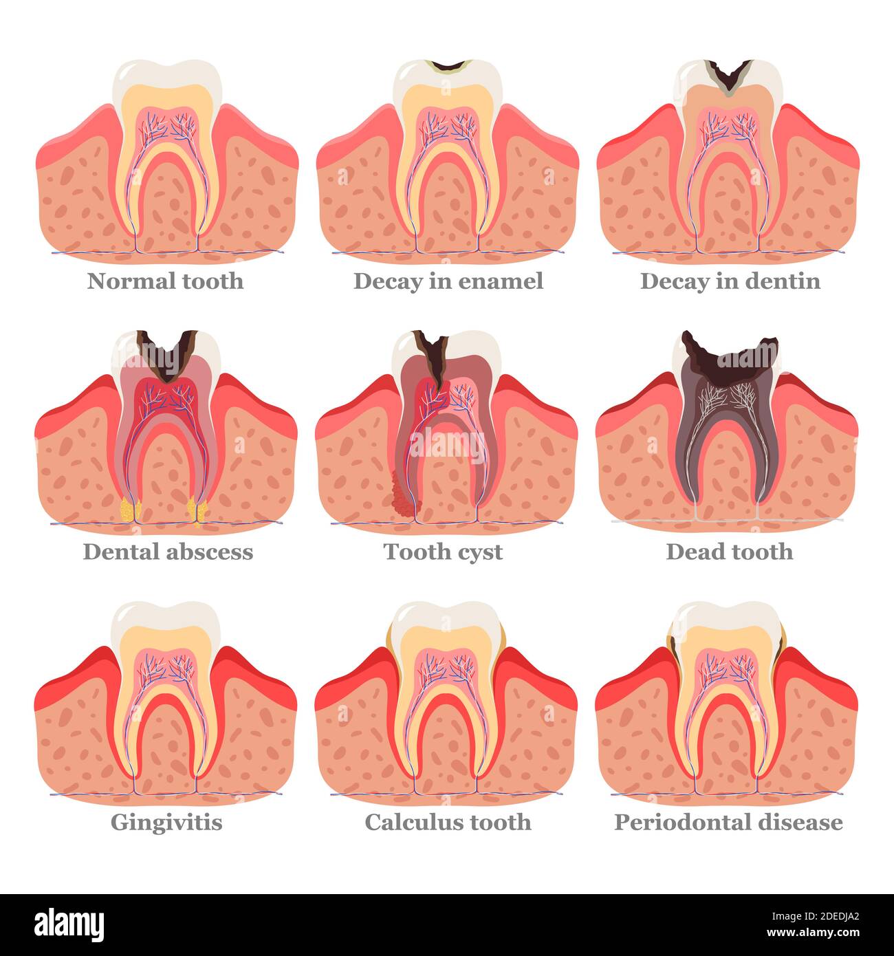 Ensemble de troubles dentaires, illustration vectorielle plate. Des dents saines et malsaines. Problèmes et maladies dentaires. Illustration de Vecteur