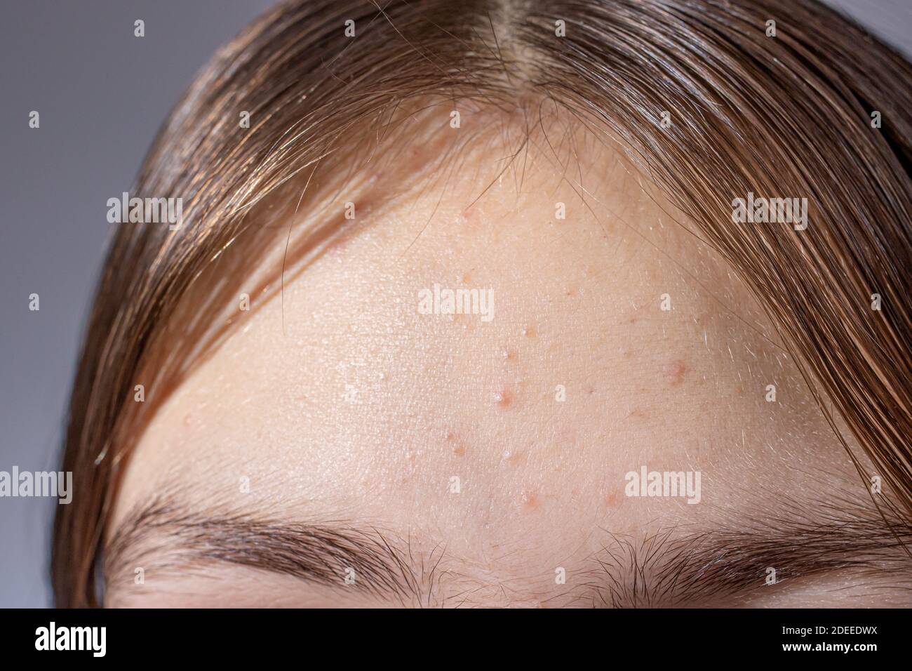 Acne treatment Banque de photographies et d’images à haute résolution Alamy