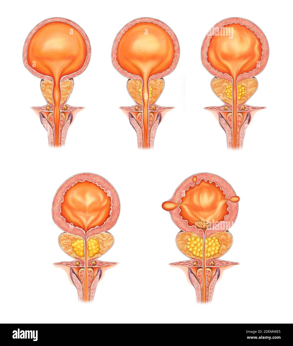 illustration anatomique de la maladie de la prostate Banque D'Images