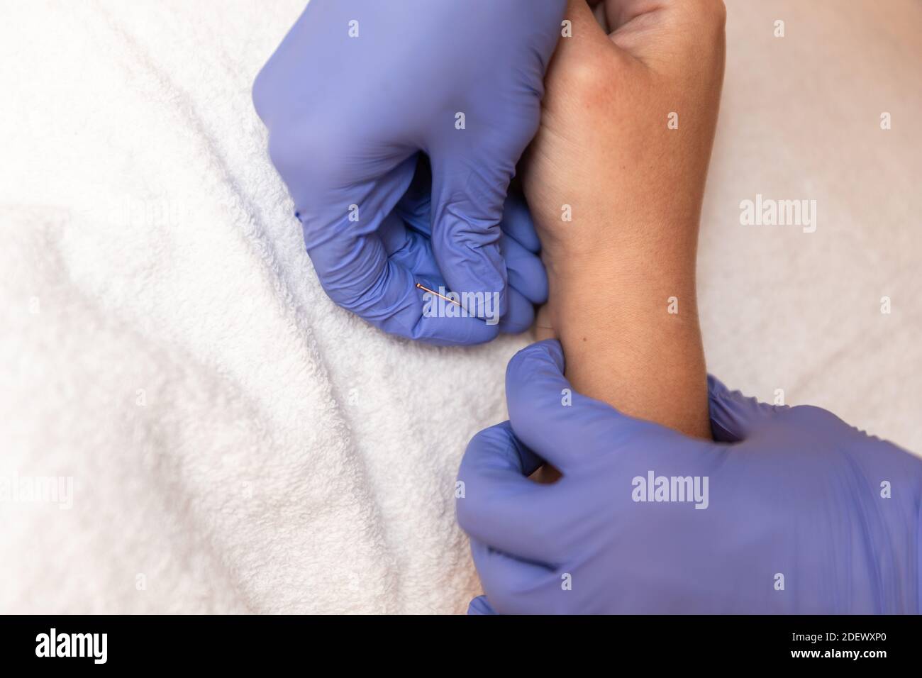 kinésithérapeute donnant le traitement avec l'acupuncture à aiguille sèche au patient dedans les mains Banque D'Images