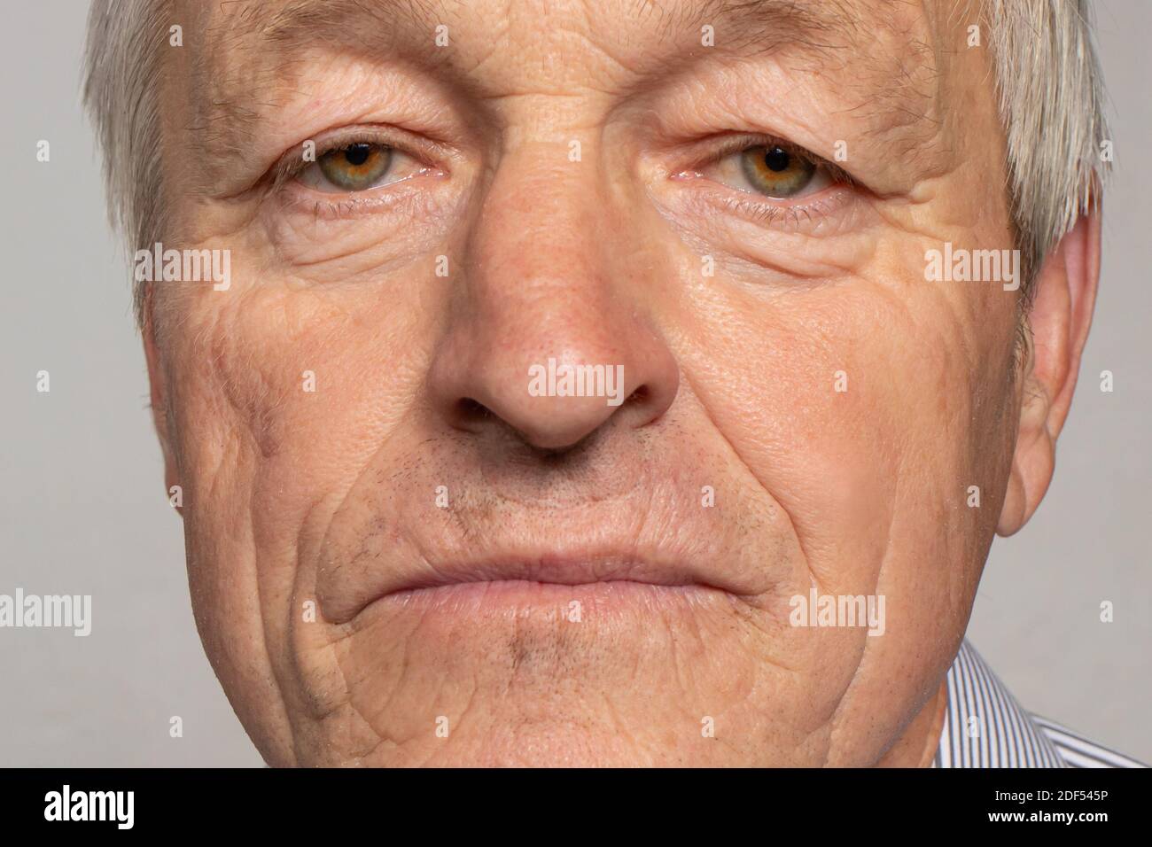 Courbure du nez après la réfraction des nouveaux os - photo macro d'un vieil homme sur fond gris. Banque D'Images