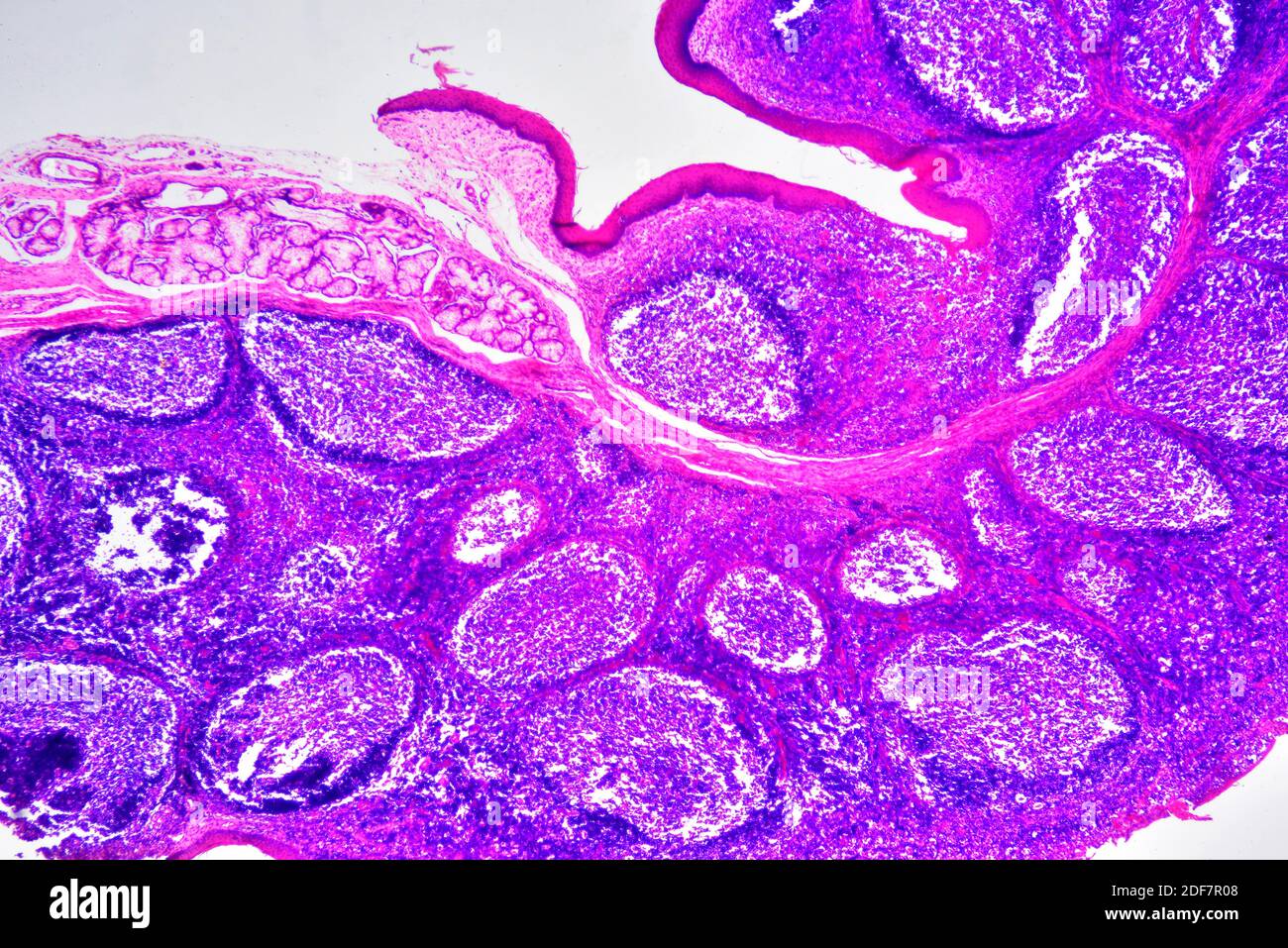 Section de amygdale palatine humaine montrant des follicules lymphoïdes circulaires et une glande sécrétoire. Micrographe léger, coloration à l'éosine d'hématoxyline. X30 lors de l'impression Banque D'Images