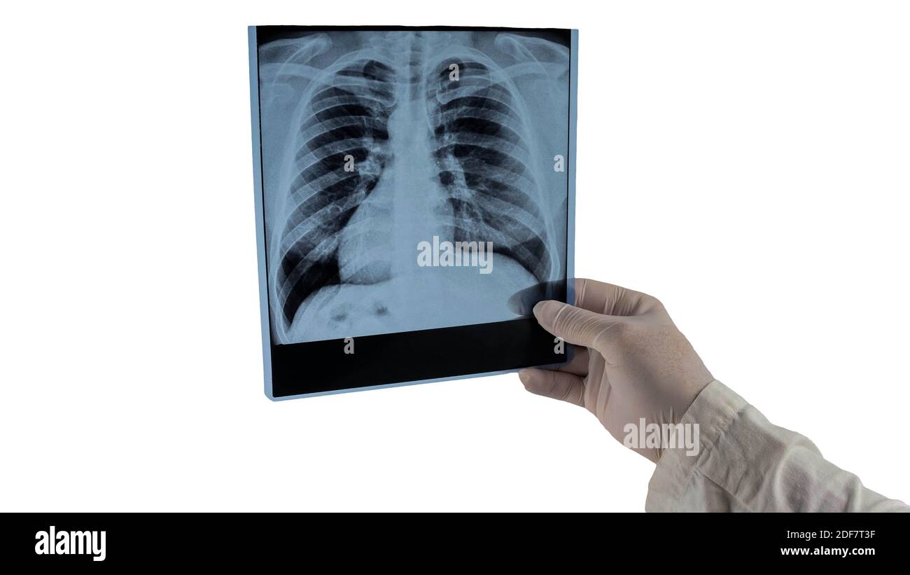 Rayons X des poumons humains isolés sur blanc, le médecin examine les poumons humains dans l'image, la pneumonie, l'oedème pulmonaire. Banque D'Images
