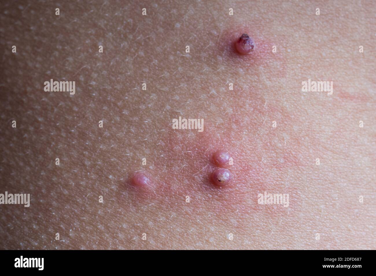 Moluskum contagiosum sur la peau d'un enfant. Banque D'Images