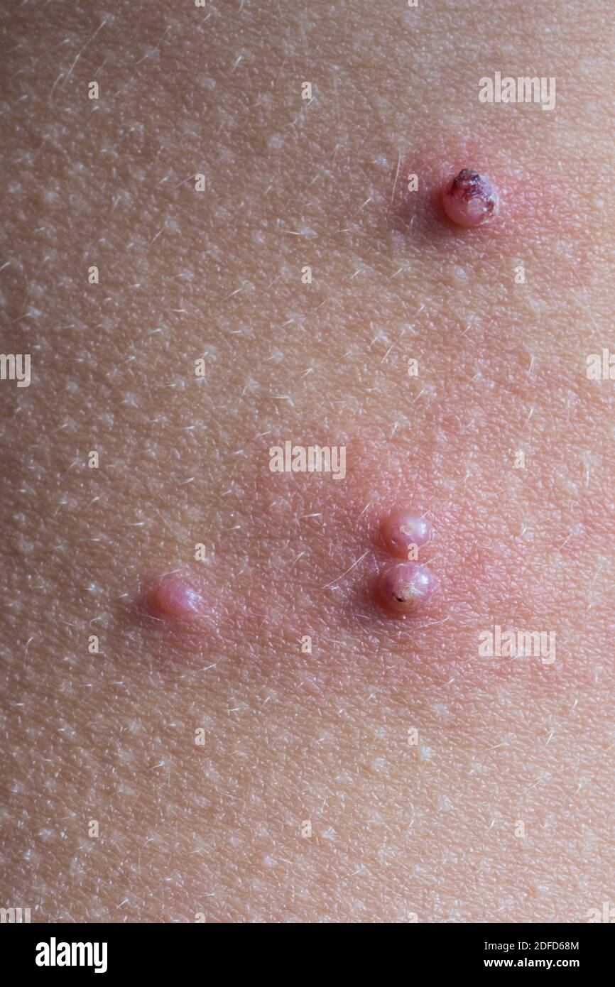 Moluskum contagiosum sur la peau d'un enfant. Banque D'Images