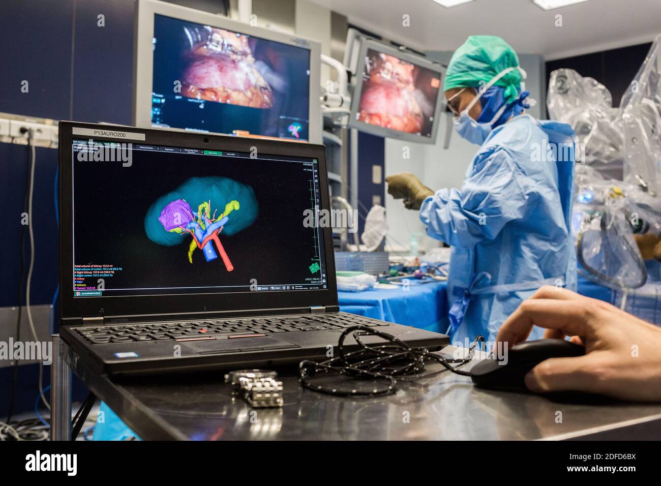 La chirurgie rénale conservatrice robotique guidée par l'image assistée par la modélisation 3D, cette modélisation 3D du rein avec sa tumeur située en violet, guide les s. Banque D'Images