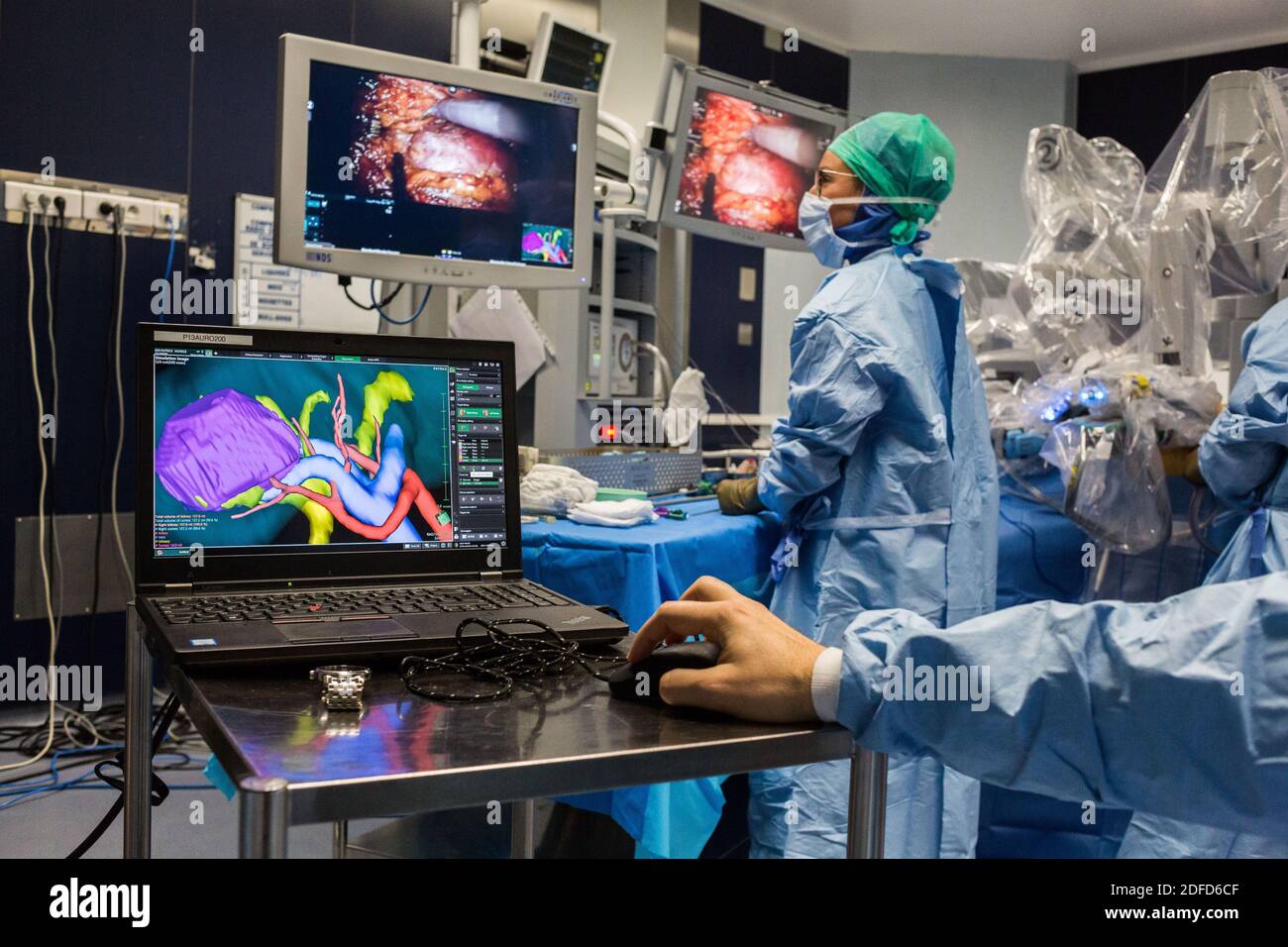La chirurgie rénale conservatrice robotique guidée par l'image assistée par la modélisation 3D, cette modélisation 3D du rein avec sa tumeur située en violet, guide les s. Banque D'Images