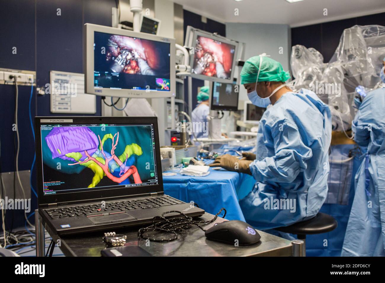 La chirurgie rénale conservatrice robotique guidée par l'image assistée par la modélisation 3D, cette modélisation 3D du rein avec sa tumeur située en violet, guide les s. Banque D'Images